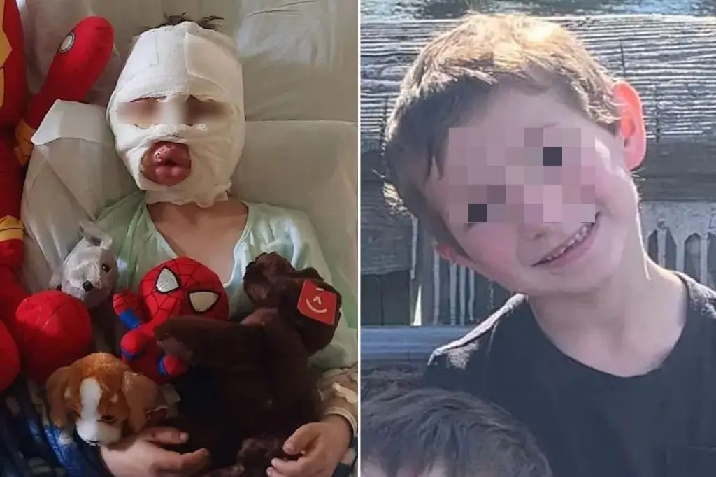 “Mamma mi hanno dato fuoco”, bimbo di 6 anni bruciato da un bullo. Le strazianti foto in ospedale