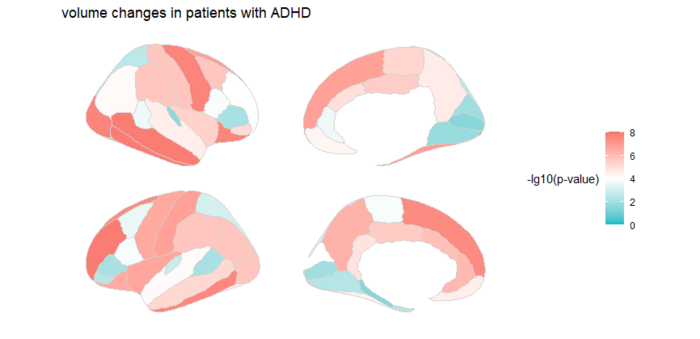 ADHD: identificati i biomarcatori cerebrali che potrebbero rivoluzionare la diagnosi del disturbo di attenzione nei bambini