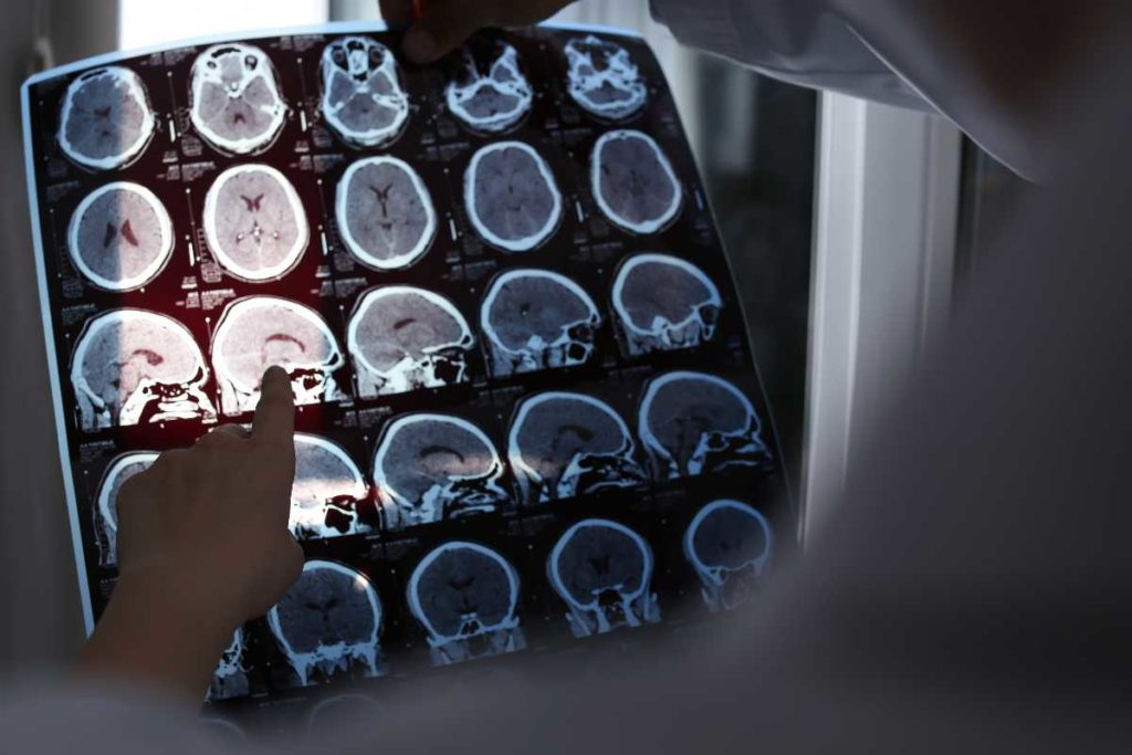 cervello alzheimer