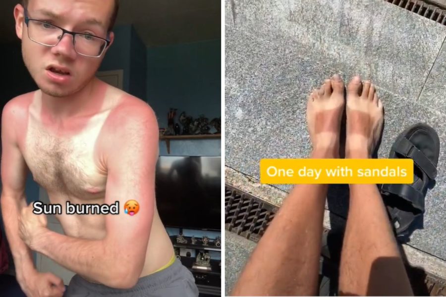 sunburnt challenge tiktok