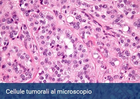 tumori cancro cellule microscopio universita statale milano