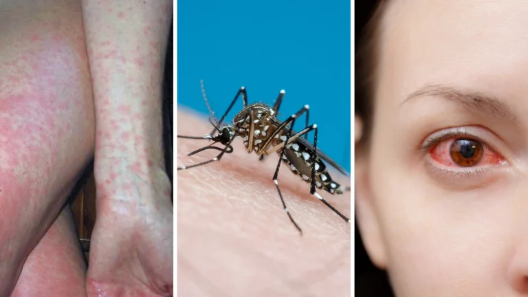 la malattia portata dalla zanzara aedes al centro puo provocare rush e dolore intenso alla testa e dietro agli occhi.webp