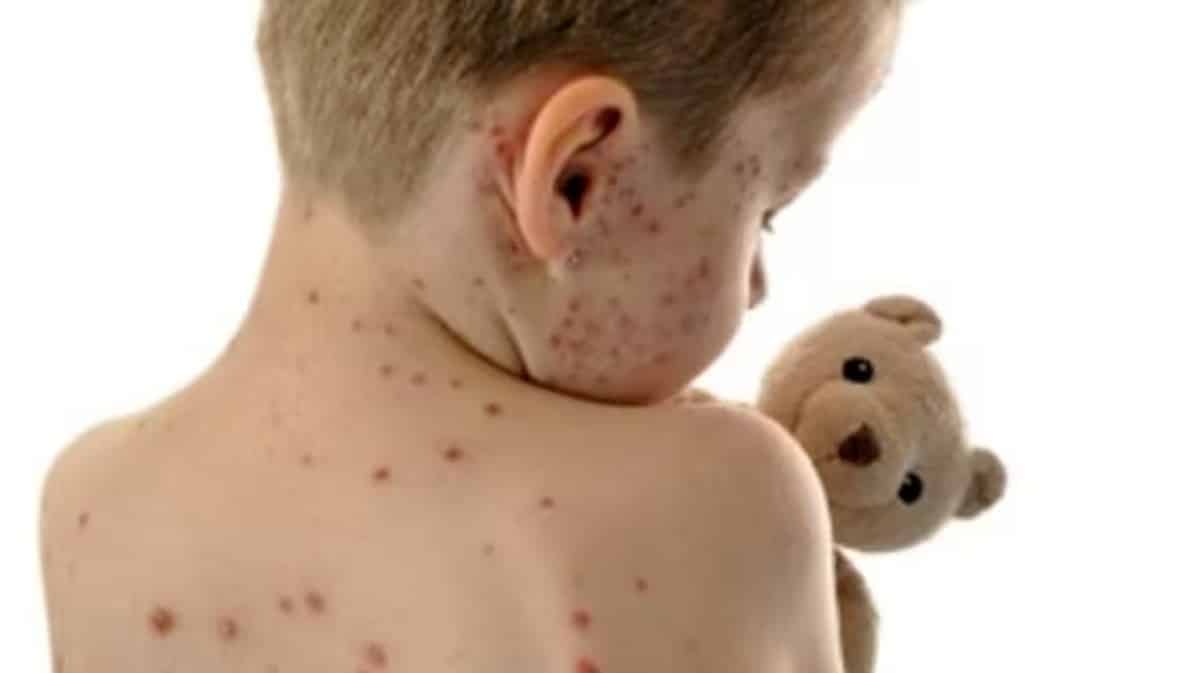 Aumento casi morbillo nel mondo: pandemia impatta vaccinazioni 1 Aumento casi morbillo nel mond.jpg