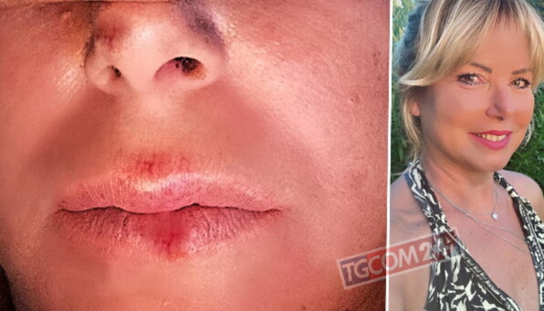 Monica Leofreddi mostra il volto tumefatto dopo essere stata investita da un van: ecco cosa è successo 1 Monica Leofreddi mostra il vol.jpg