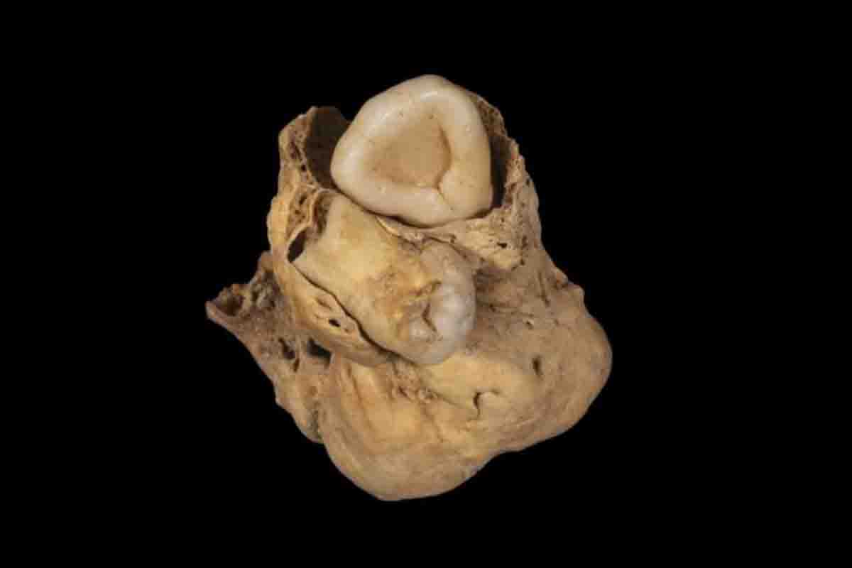 Pensavano fosse un feto, ma questo fossile simile a un dente si rivela essere il tumore più antico del mondo 1 tumore piu antico del mondo.jpg