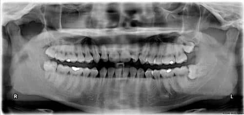 wisdom teeth m.jpg