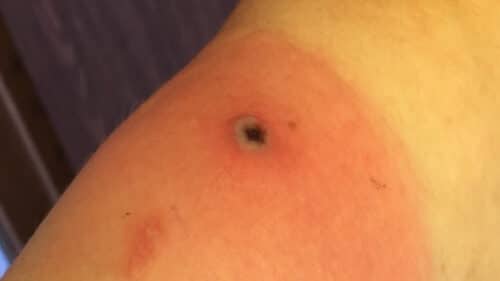 PoxLesion 1 500x281.jpg