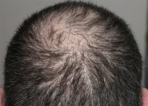 alopecia 500x359.jpg