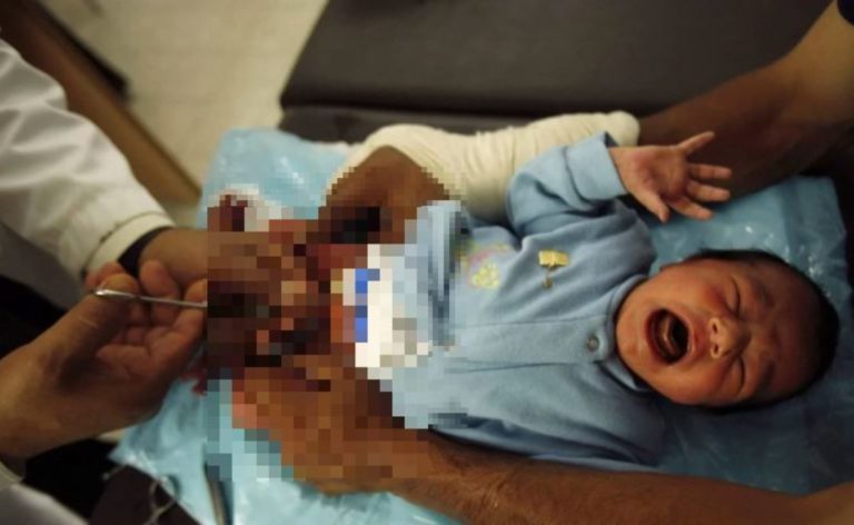 neonato morto circoncisione.jpg