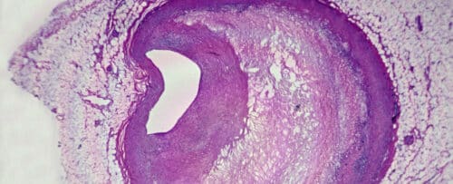 CrossSectionOfCoronaryArteryAtherosclerosis 500x203.jpg