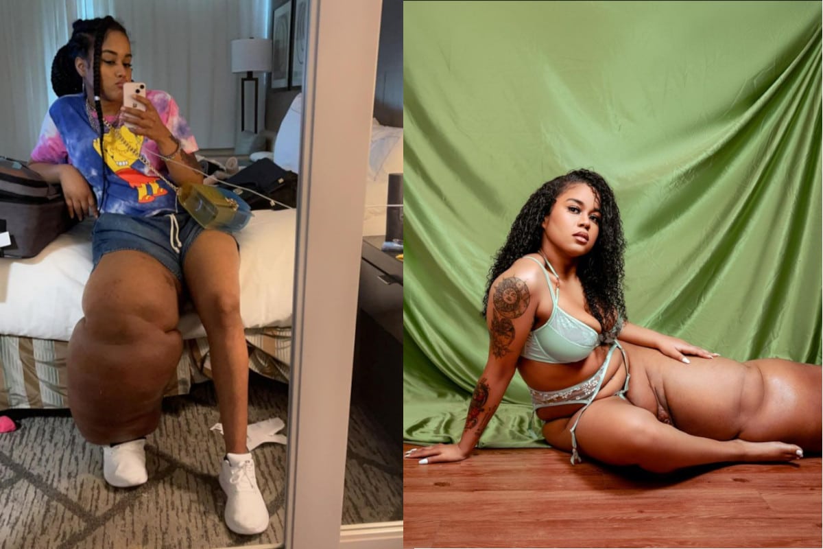 “Ho un linfedema alla gamba di 45 kg e sono bella” la storia della modella che ha imparato ad amarsi così com’è 1 Gamba 45 kg.jpg