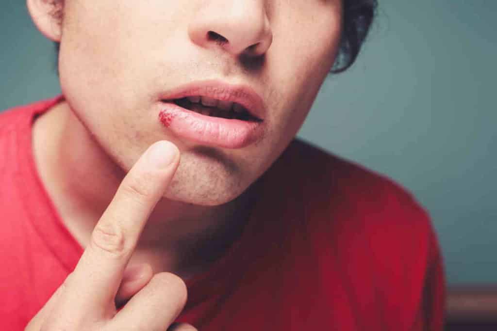 herpes labiale.jpg