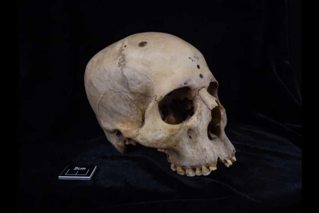 Cranio cancro.jpg