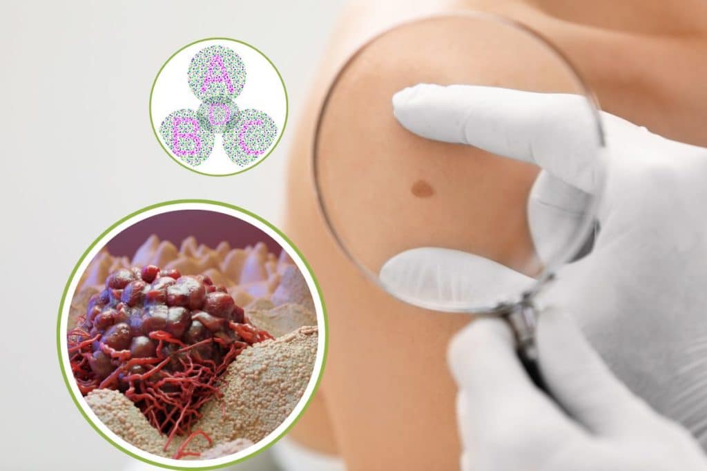 melanoma metodo.jpg