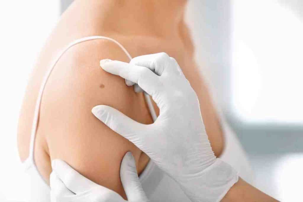 cancro pelle.jpg