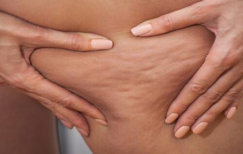 I trattamenti anticellulite funzionano davvero? Ecco la risposta degli esperti 1 cellulite vs ritenzione 900x760 1 500x317.jpg