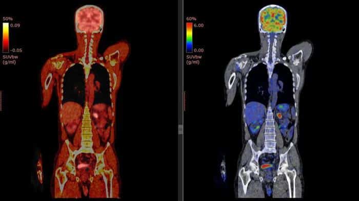 pet ct scan m.jpg