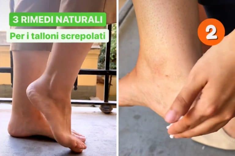 rimedi per talloni screpolati tiktok.jpg