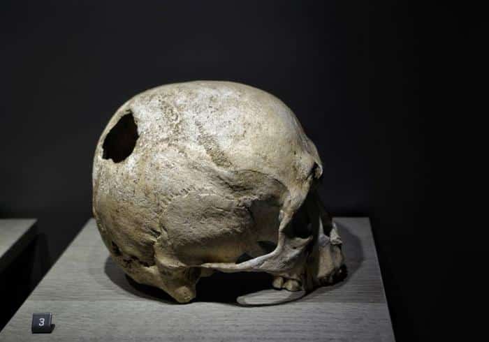 trepanation m.jpg