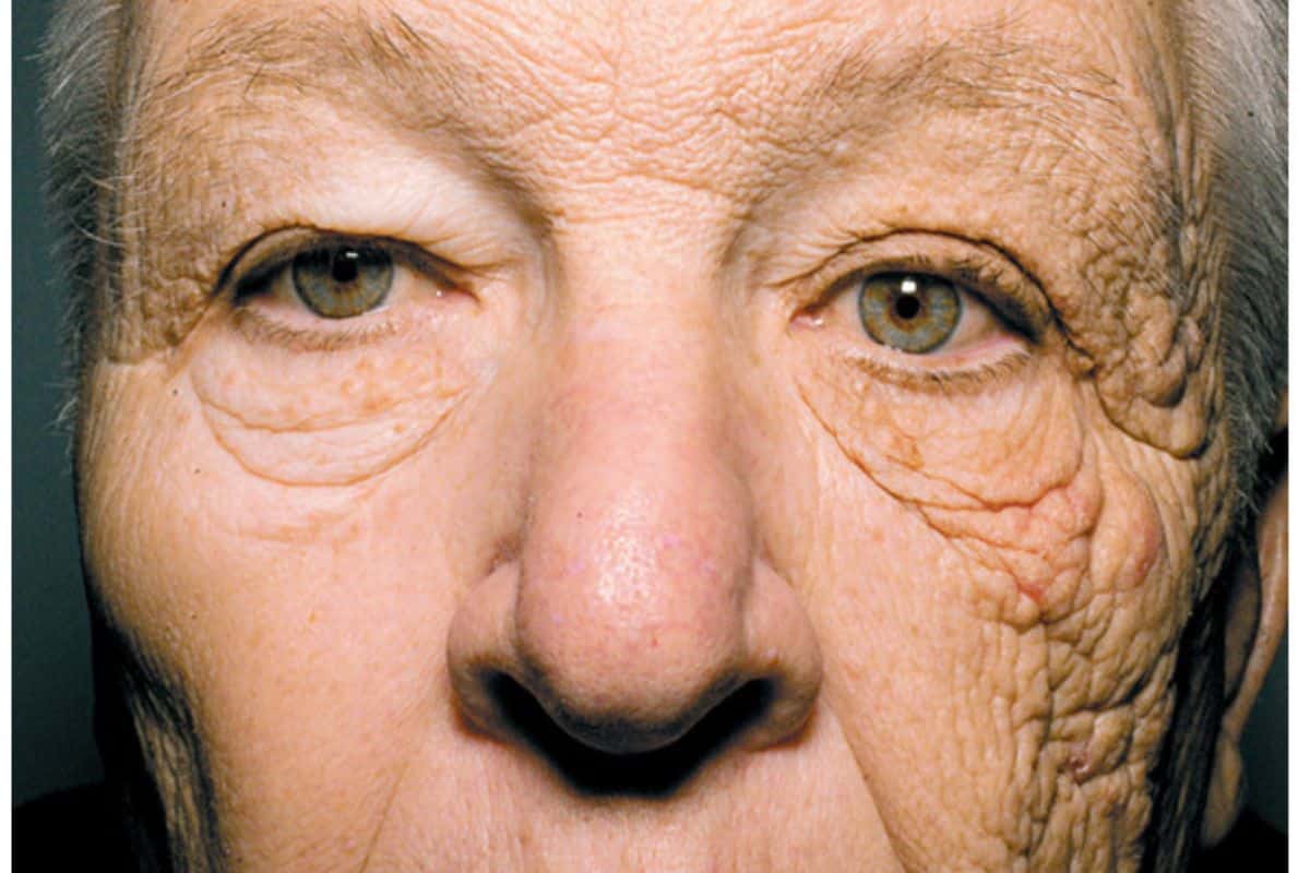 Creme solari: l’immagine shock del viso di questo camionista, invecchiato di più da un lato, ci ricorda di usarle sempre 1 camionista pelle rovinata dal sole.jpg7 .jpg