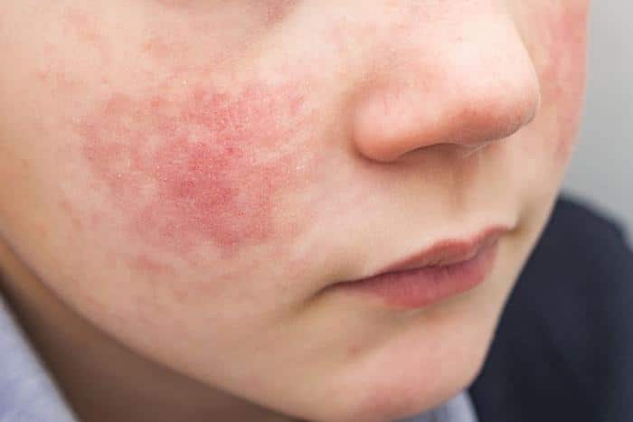 rash m.jpg