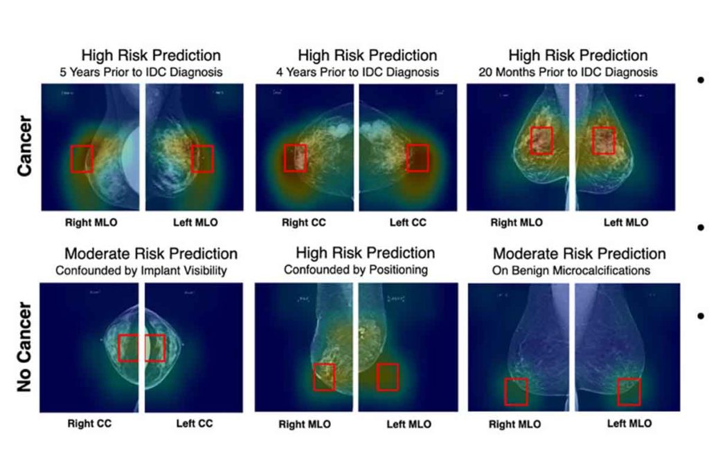 Rilevazione cancro al seno con Intelligenza Artificiale Radiology.jpg