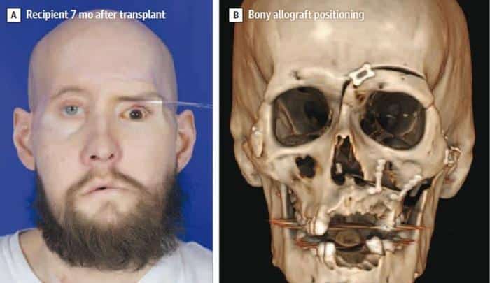 eye and face transplant m.jpeg