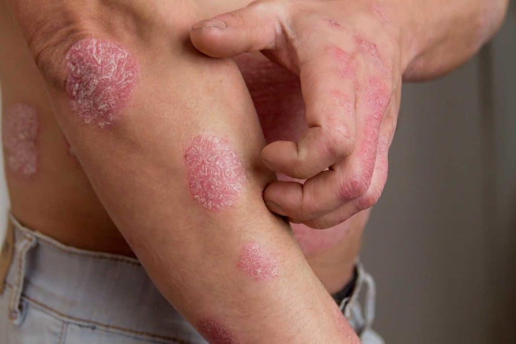psoriasi.jpg