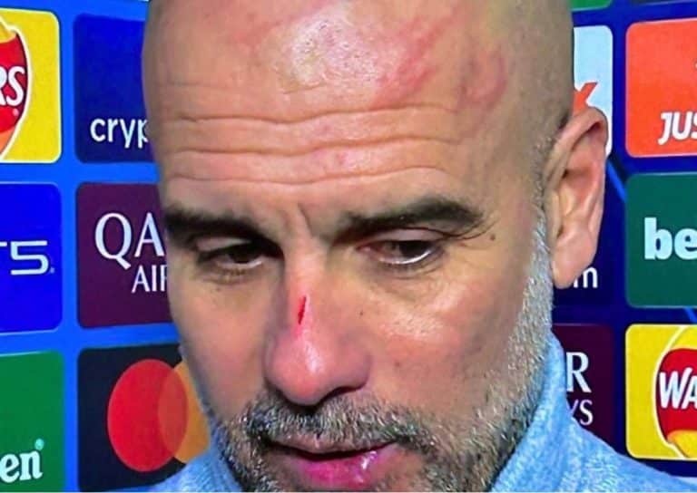 Guardiola come Sangiuliano graffi sulla testa e in viso. Lallenatore Volevo farmi del male.jpg