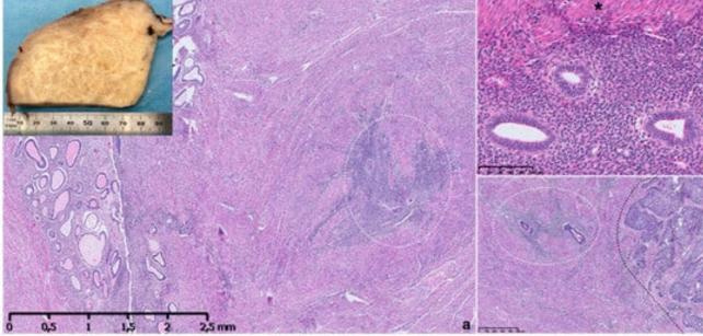 Macroscopic and microscopic appearance of adenomyosis.jpg