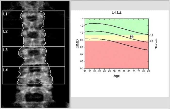 Levotiroxina e Perdita Ossea negli Anziani: Risultati dello Studio 1 Bone Density Scan 777x499 1.jpg