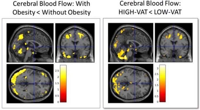 Cerebral Blood Flow Obesity 777x428 1.jpg