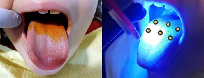 Photodynamic Therapy With Annatto Colorant 777x299 1.jpg