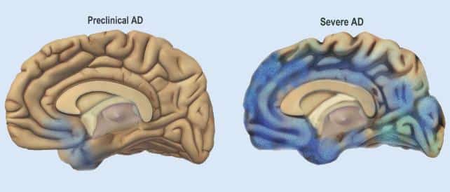 brain shrinkage humans.jpg