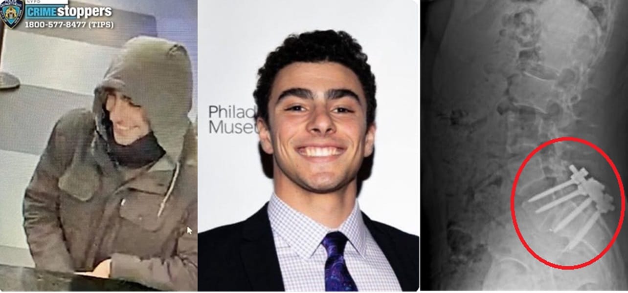 luigi mangione operazione schiena malattia killer ceo new york.jpg