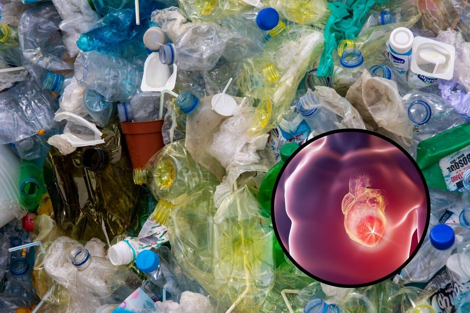 plastica infarto.jpg