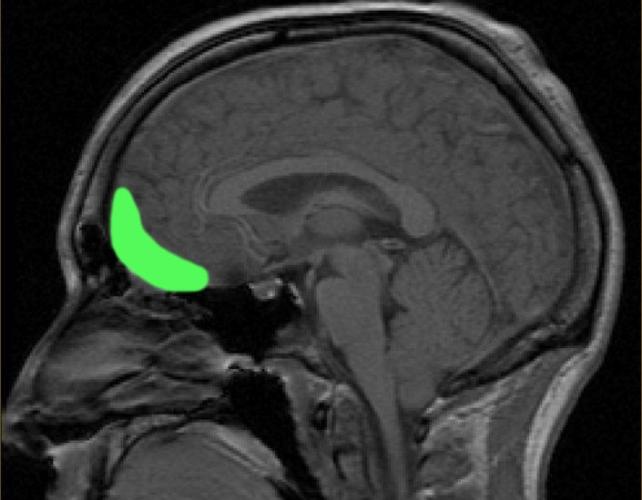 OrbitofrontalCircuitBrainMRI642.jpg