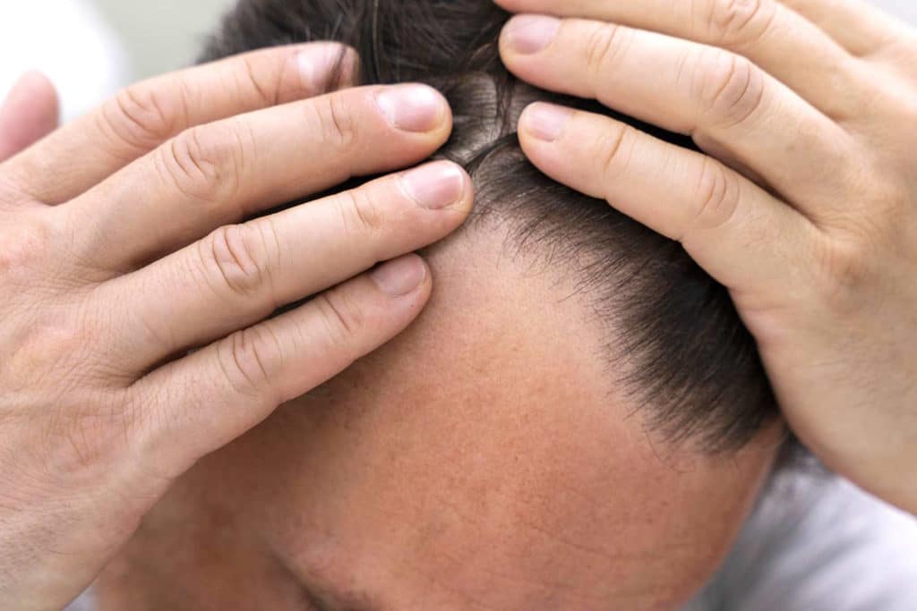 caduta capelli.jpg