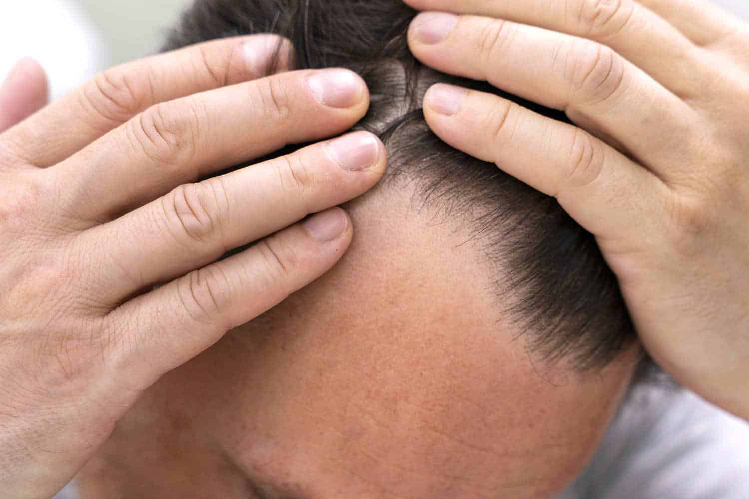 caduta capelli.jpg