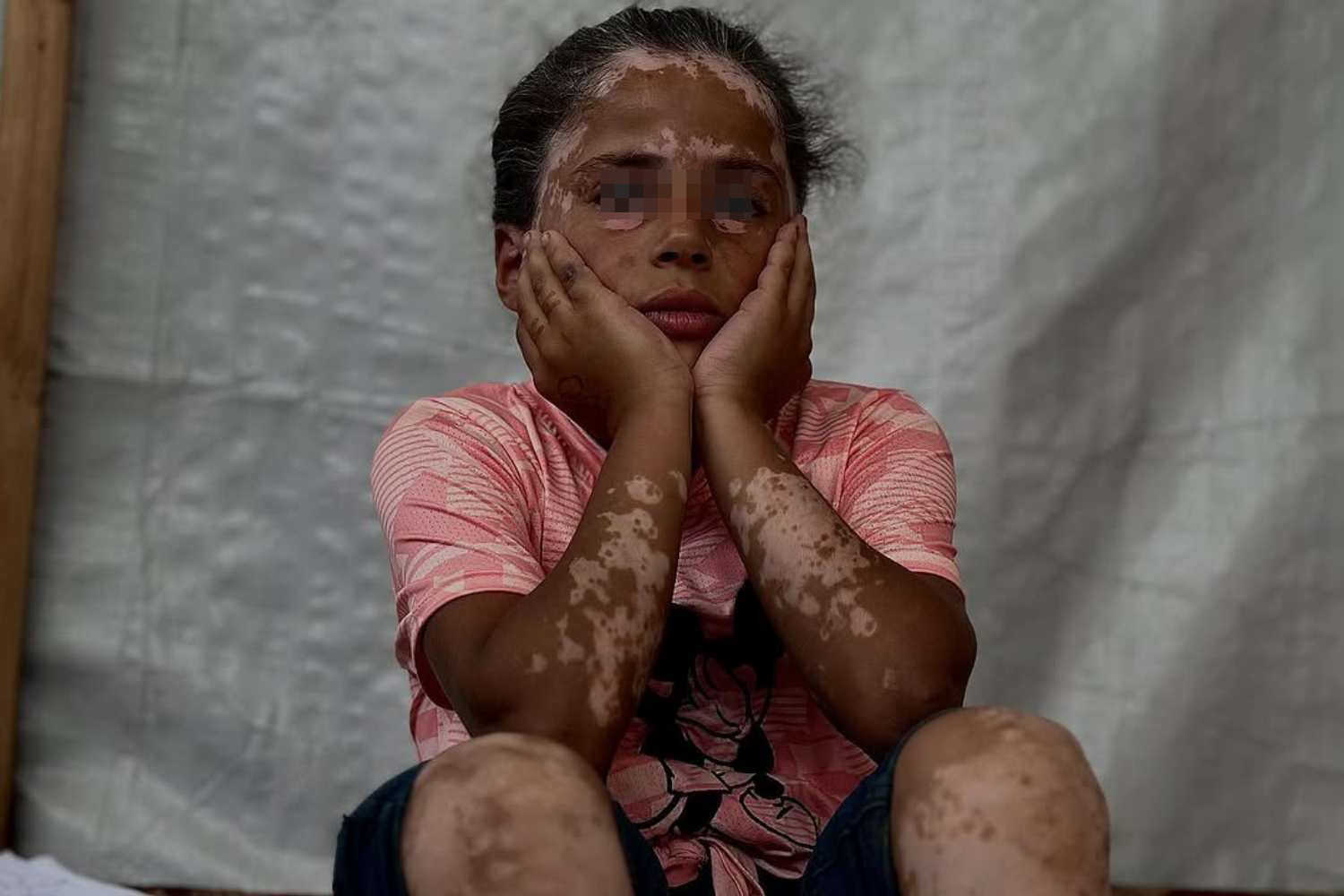 Lana, la bambina di Gaza a cui sono diventati i capelli grigi e che soffre di vitiligine per lo shock dei bombardamenti 1 Lana al Sharif.jpg