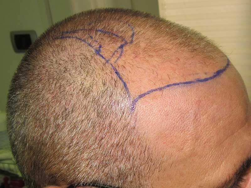 Le innovazioni del 2025 nel trapianto Capelli per Masullo Medical Group 1 capelli