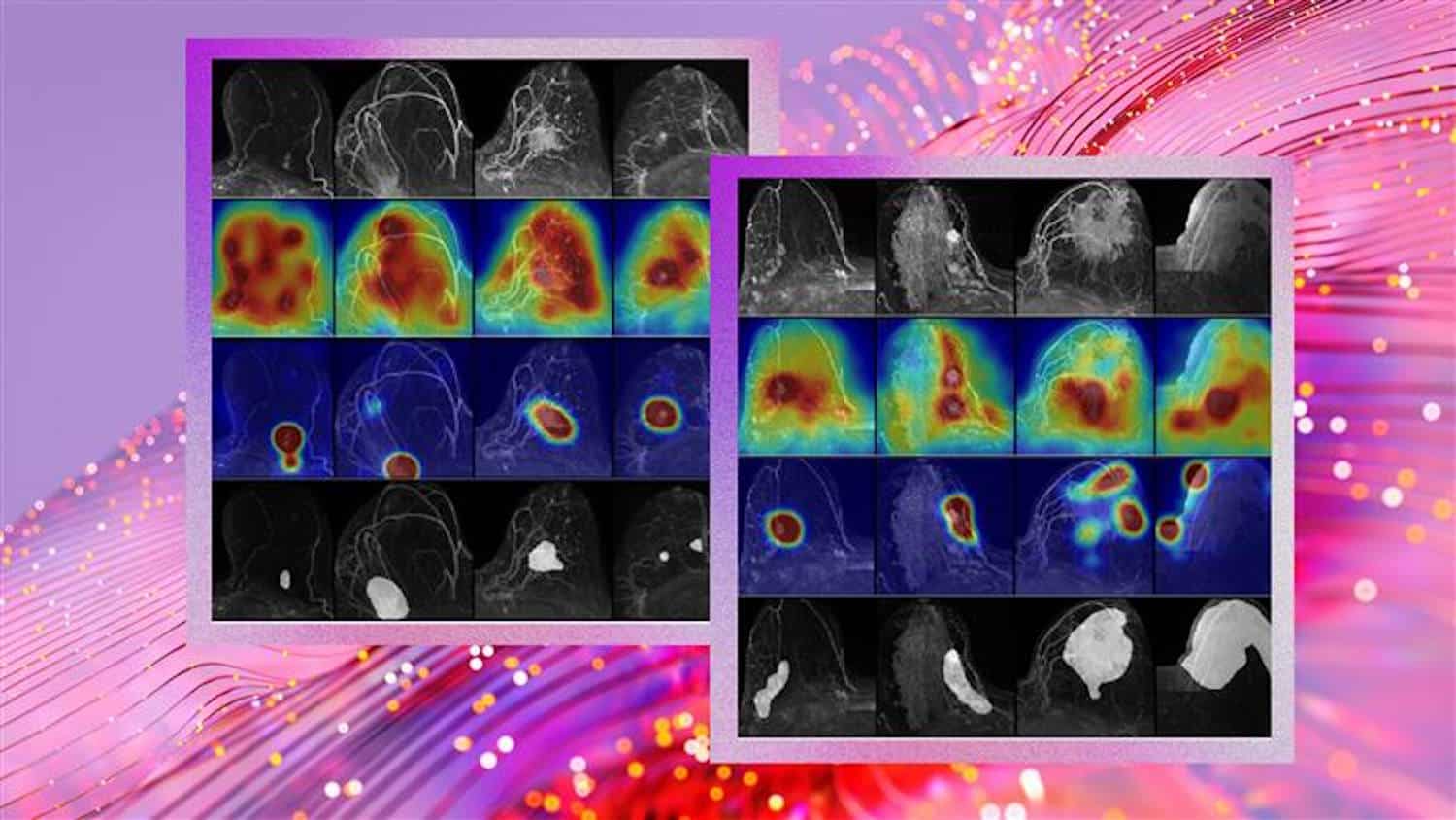 cancro al seno screening intelligenza artificiale
