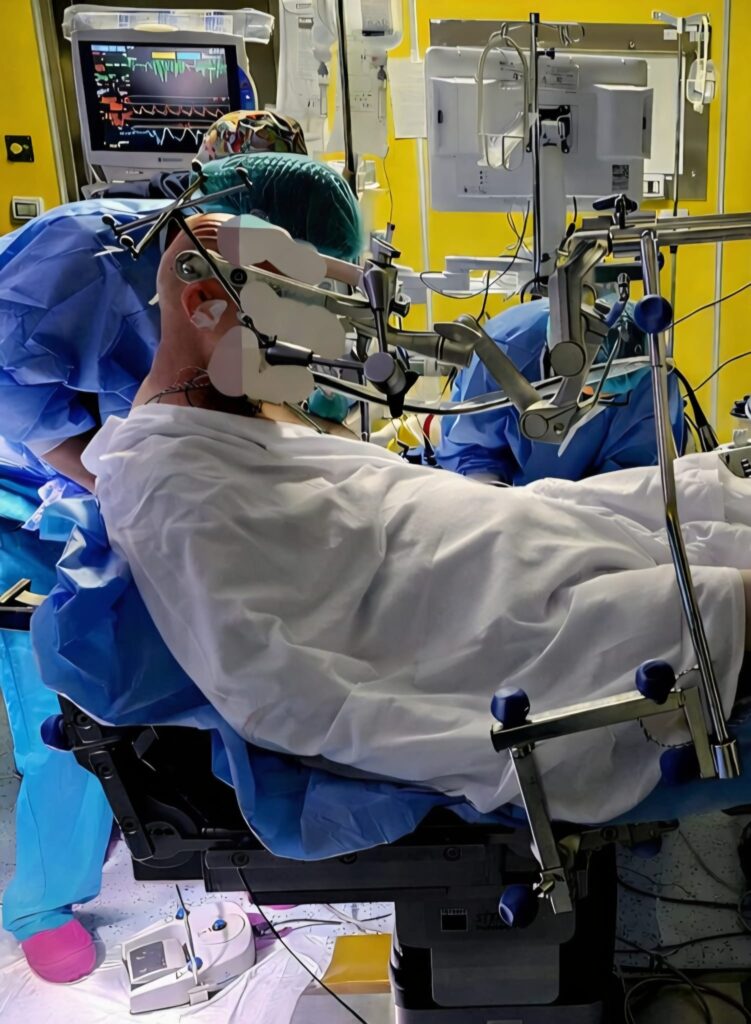 Frosinone, 'Spaziani': top neurochirurgia: raro meningioma rimosso con un intervento di 10 ore 2 intervento3